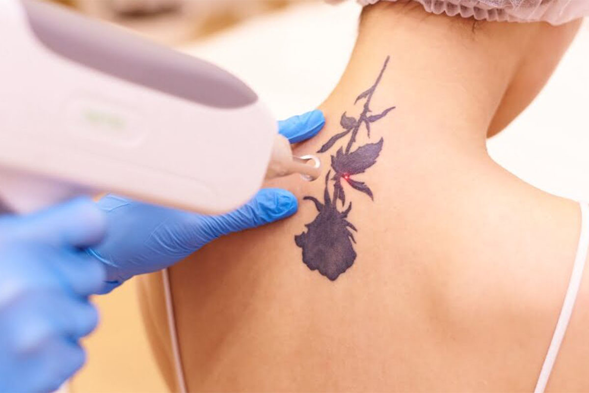 Laser Tattoo Removal - London Real Skin